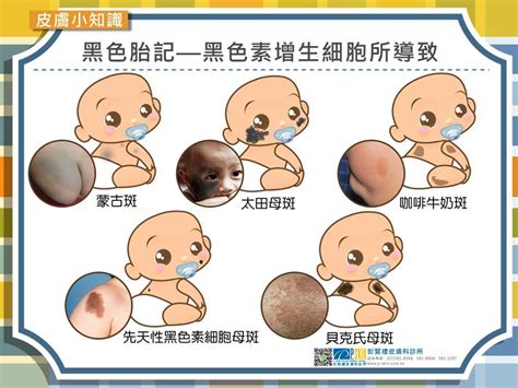 膝蓋有胎記|認識胎記的種類與治療照顧